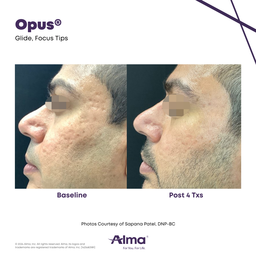 Before Acne Scar Treatment